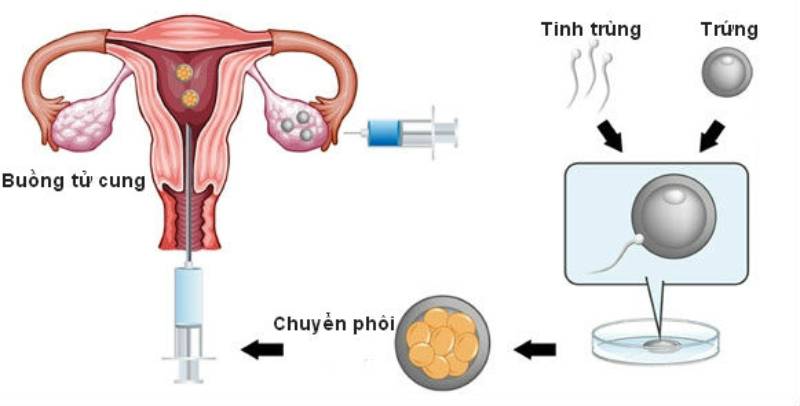 Tìm hiểu về thụ tinh trong ống nghiệm (IVF)